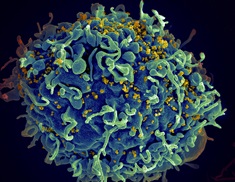 Electron micrograph of HIV particles infecting a human T cell